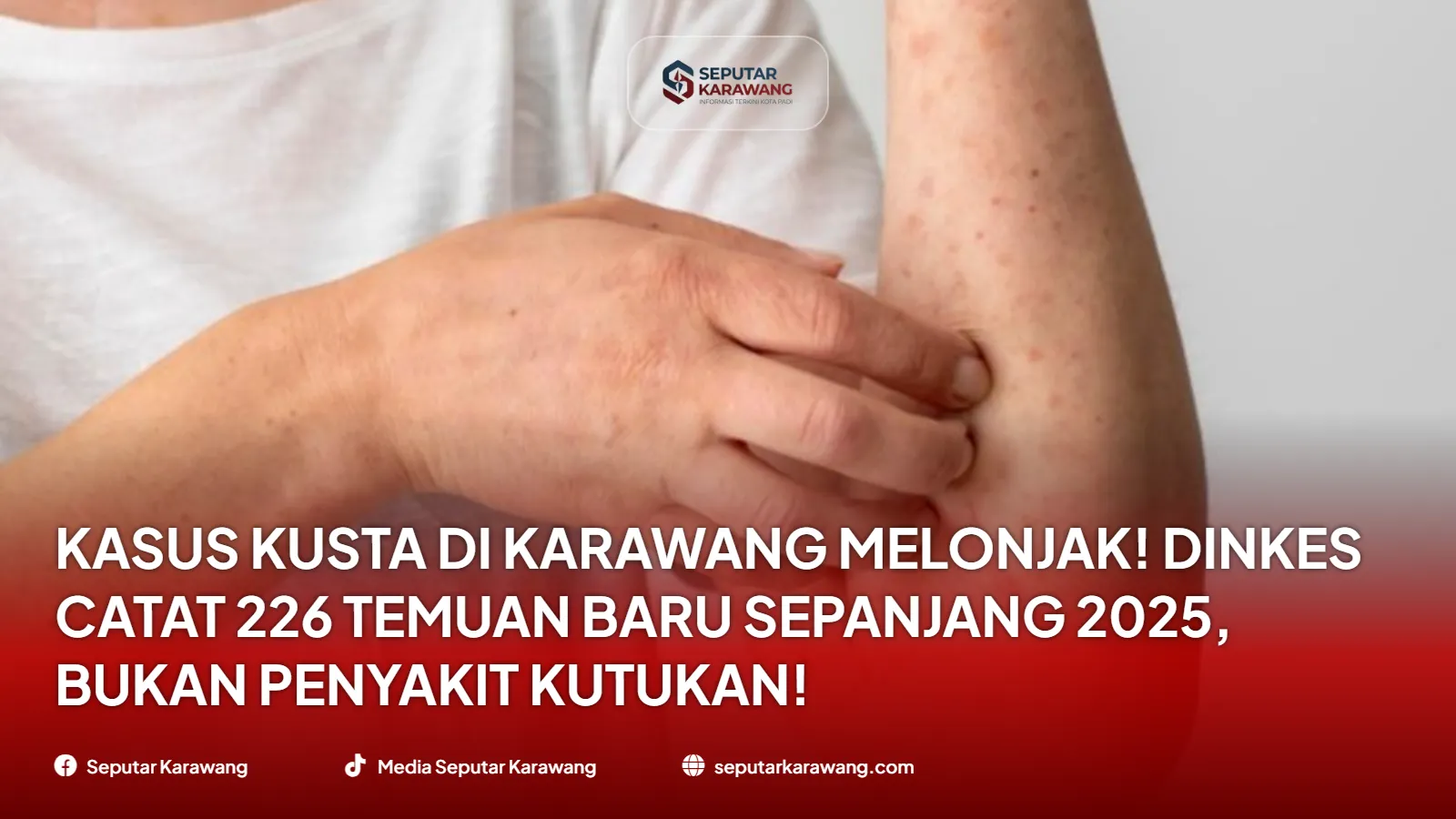 Kasus Kusta di Karawang Melonjak! Dinkes Catat 226 Temuan Baru Sepanjang 2025, Bukan Penyakit Kutukan!